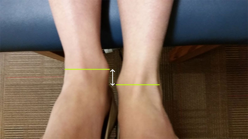 spine problem without insole orthotics