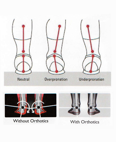 over pronation problem