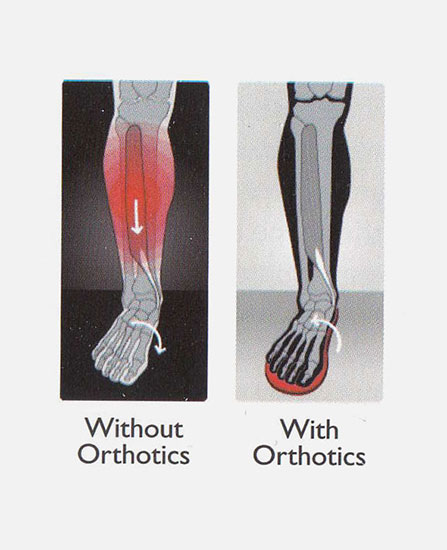 shin slpints problem